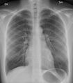 Projectional_radiography