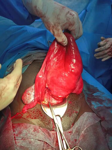 File:An atonic uterus.jpg
