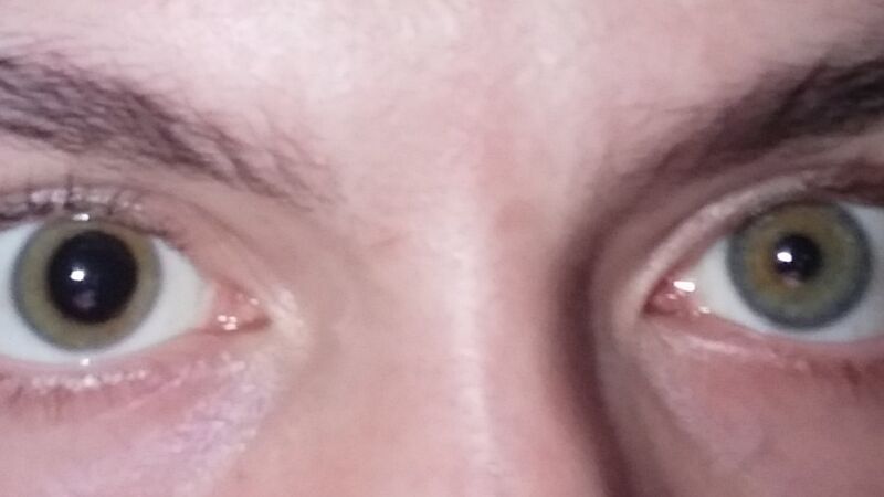 File:Anisocoria0.jpg