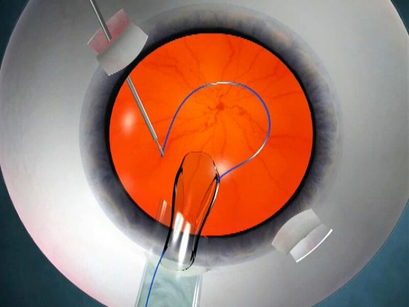 File:Animation showing glued IOL surgery.jpg
