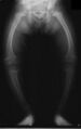 X-ray of rickets