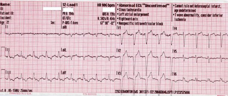 File:12 lead sinus tachycardia old.JPG