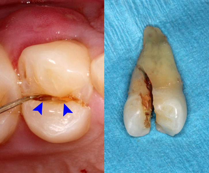 File:Cracked tooth.png