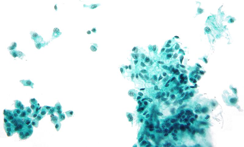 File:Pleomorphic adenoma - cytology.jpg