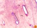 Bone decalcification at 100x magnification