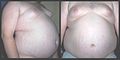 Truncal obesity, central accumulation of body fat