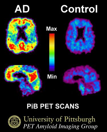 File:PiB PET Images AD.jpg