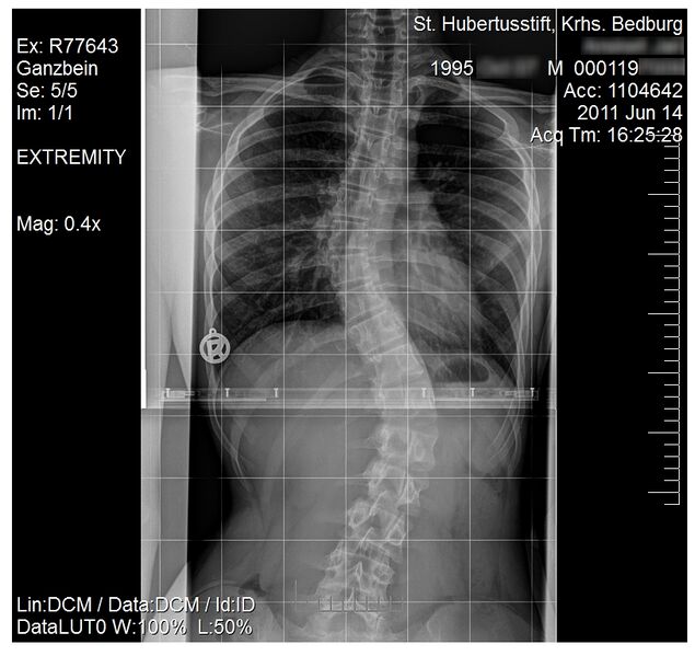 File:Scoliosis (15-year-old).jpg