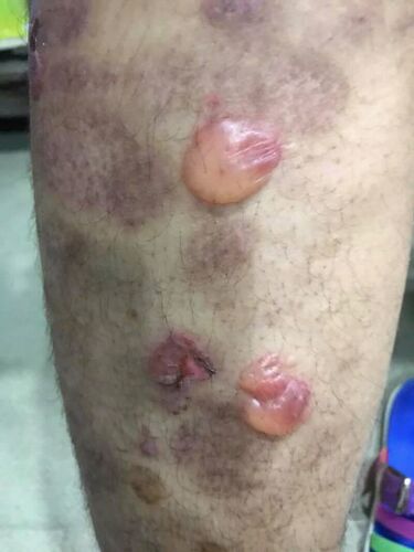 File:Bullous pemphigoid new image.jpg