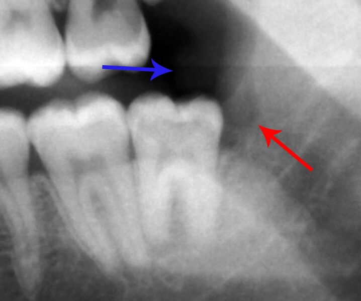 File:38 pericornitis xray.jpg