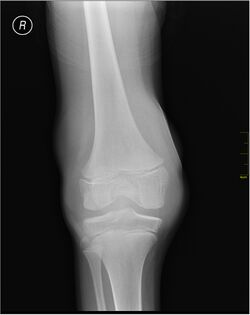 Hemarthrosis