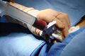 Hematopoietic stem cell transplantation