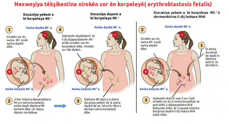 File:Eritroblastosis fetalis ku.png