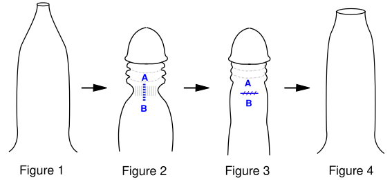 File:Preputioplasty.svg