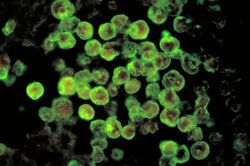 Histopathology of amebic meningoencephalitis due to Naegleria fowleri.