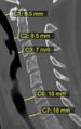 Prevertebral space