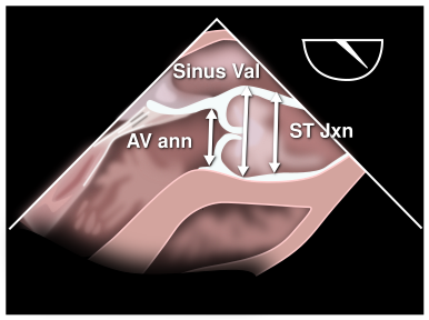 File:Fig009 (CardioNetworks ECHOpedia).svg