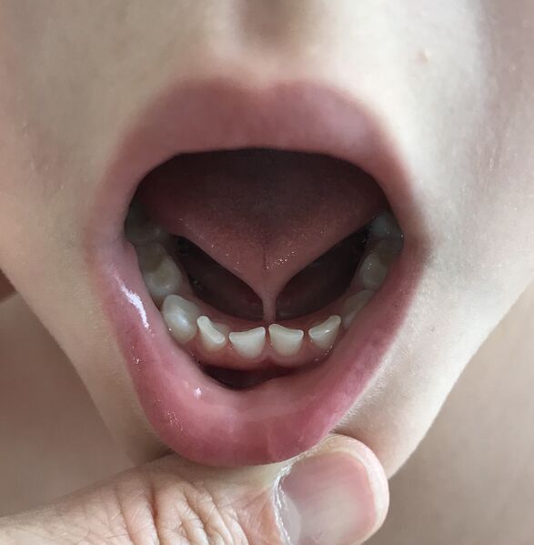 File:Ankyloglossia 1.jpg