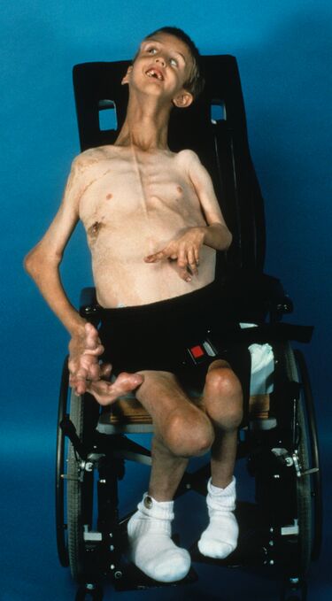 File:NIH Proteus Patient.jpg