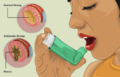 Asthma patient using an inhaler