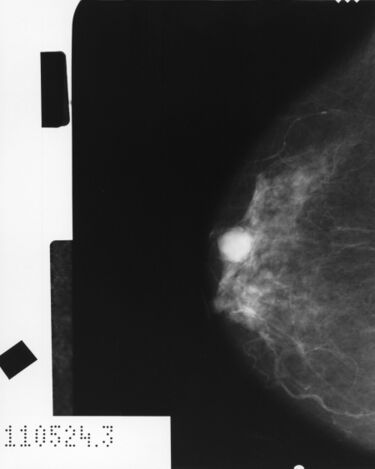 File:Mammogram showing cancer.jpg