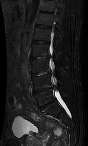 File:Lumbar spinal stenosis 3 9.png