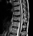 Myelitis