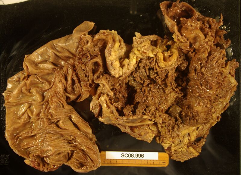 File:Toxic megacolon 1.JPG
