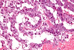 Testicular Cancer Incidence