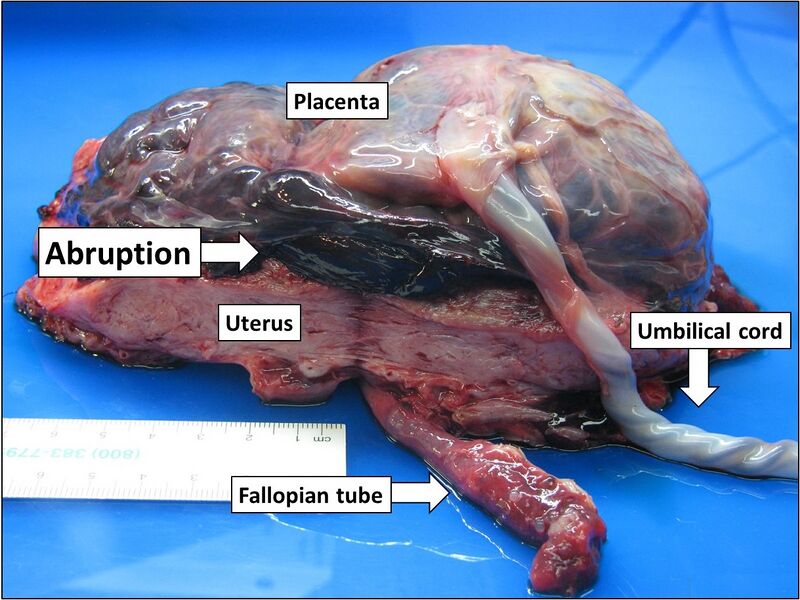 File:Gross pathology of placental abruption.jpg