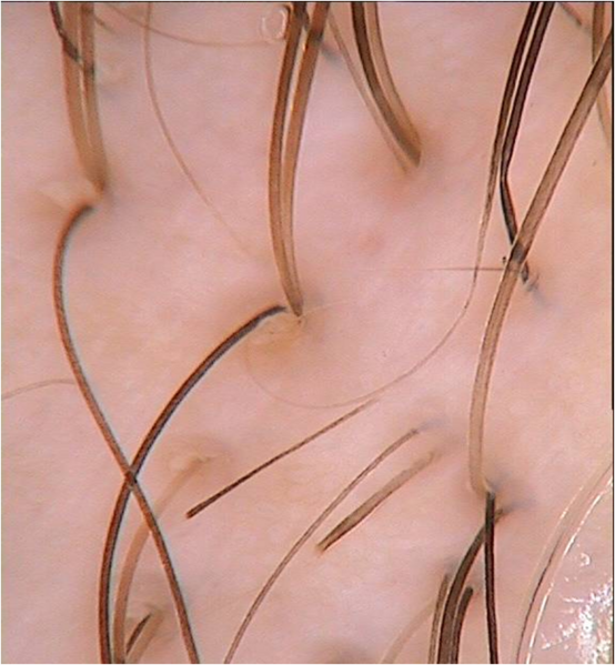 File:Trichoscopy AA.png