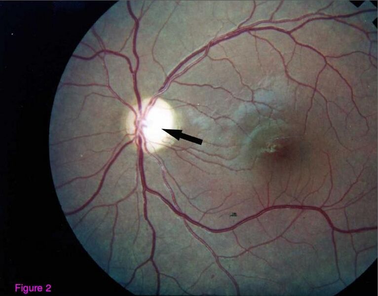 File:Optic atrophy Wolfram syndrome left.JPG