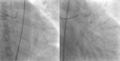 Wellens' syndrome ECG pattern