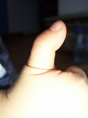 File:Tenosynovitis-3.JPG