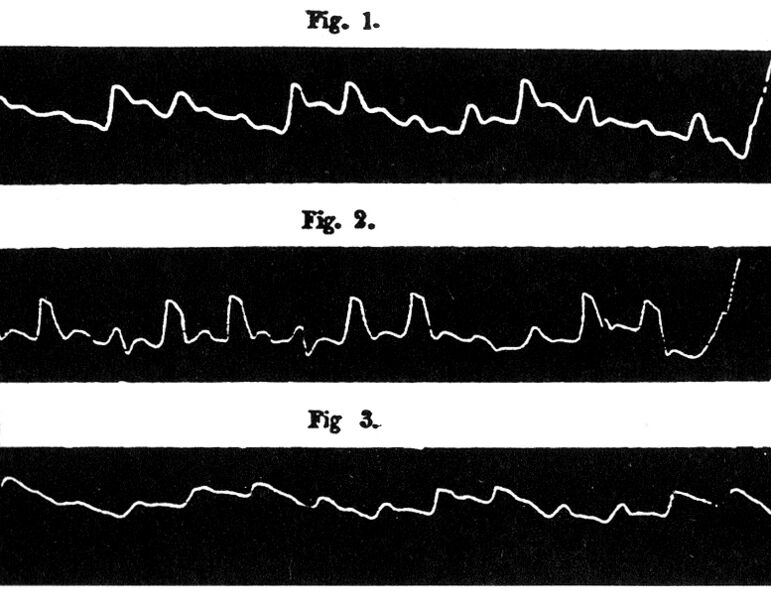 File:Kussmaul Puls.jpg