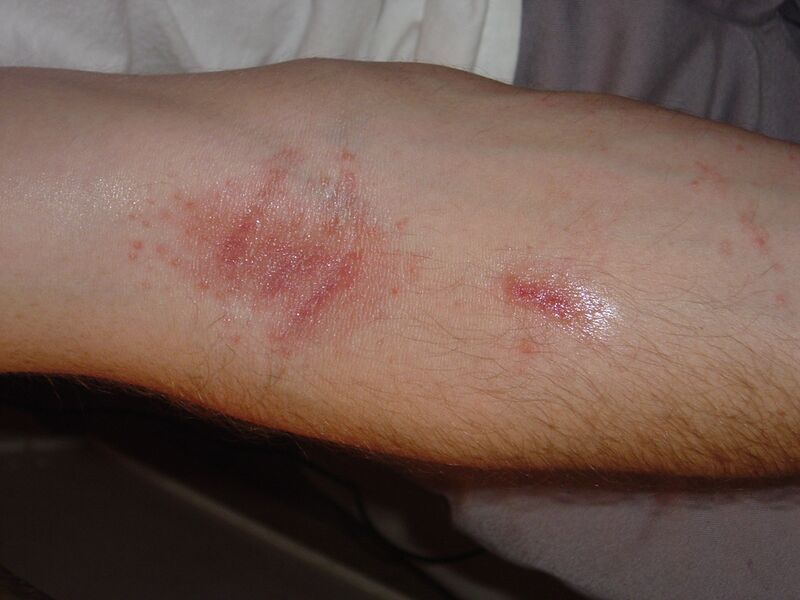 File:Poisonivyrash.jpg