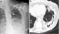 Fibrothorax