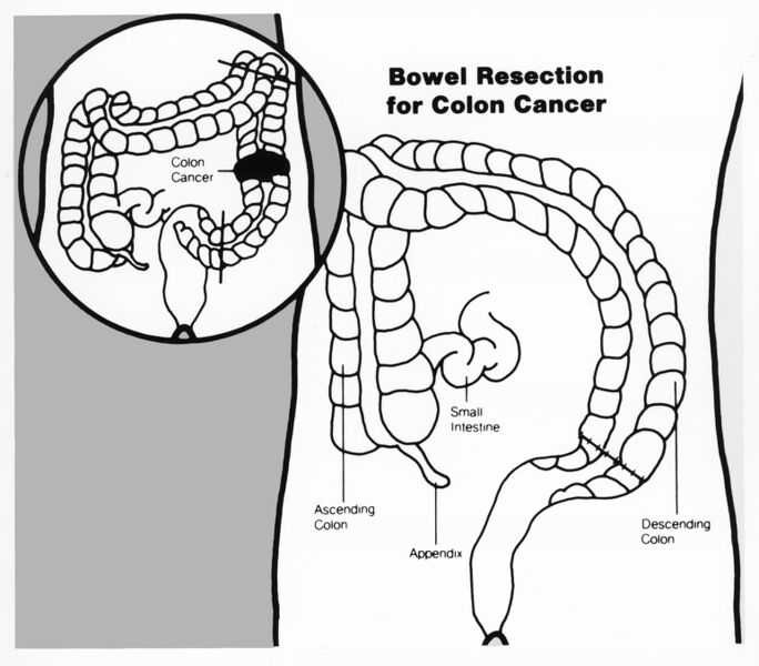 File:Bowel resection illustration.jpg