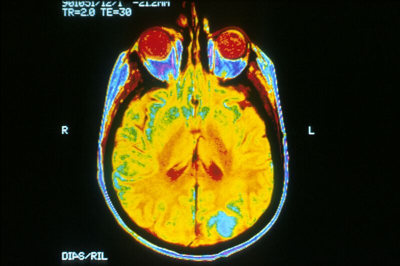 File:Brain MRI.jpg